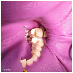 Algenpulver für 5 Minuten in den Zähnen nach der Amalgam-Entfernung (© Doc S)