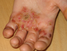 Neurodermitis Atopische Dermatitis Handekzem