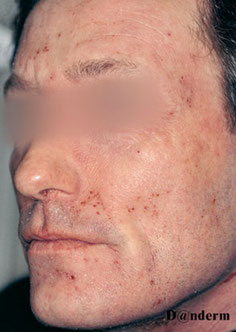 head and neck dermatitis
