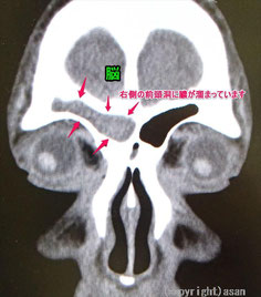 頭痛　副鼻腔炎　前頭洞炎