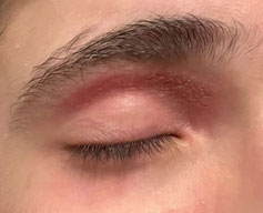 eczema paupiere en cours de traitement