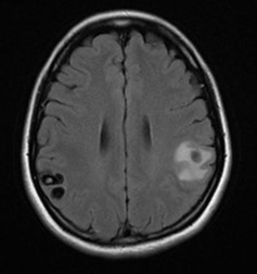 Neurocysticercosis FLAIR