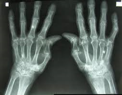 Arthritis