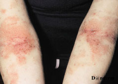 eczema modere a severe des plis des coudes