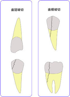 歯冠破折と歯根破折