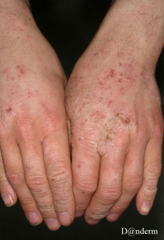 eczéma irritatif des dos des deux mains avec peau très sèche