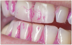 Putzkontrolle in der Zahnarztpraxis: Anfärben des Zahnbelags. (© proDente e.V.)