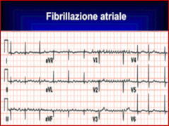 Fibrillazione atriale;le onde f di fibrillazione hanno voltaggi simili a quelle delle F del Fut-ter ma sono irregolari.