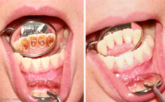 Zahnstein vor und nach der Entfernung