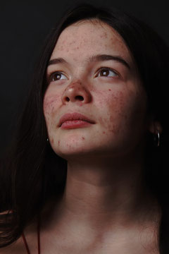 eczema et acne