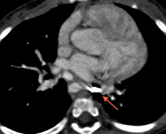 Exemple de visualisation d'un clip chirurgical après occlusion d'une MAPCA