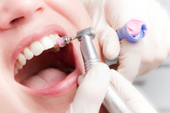 Bei der Professionellen Zahnreinigung wird der gesamte Zahnbelag von Profis entfernt (© proDente e.V.)