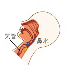 背中を倒す仰臥位では、鼻水は喉の背中側に沿って流れ気管に向かっていく