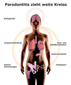 Zahnfleischerkrankungen können zu anderen Organ- oder Systemerkrankungen führen (© proDente e.V.)