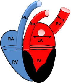 HCM mit Rückstau in linkes atrium und Pulmonalvene; RA: rechtes Atrium; RV: rechter Ventrikel; Pu: Pulmonalarterie; LA: linkes Atrium; LV: linker Ventrikel; PV: Pulmonalvene; Ao: Aorta