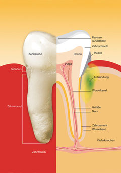 Wie Parodontose beginnt: Klicken Sie auf die Grafik, um sie zu vergrößern! (© proDente e.V.)