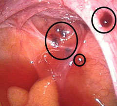 Implantes de endometriosis en el saco de Douglas (centro) y en el ligamento sacrouterino (esquina superior derecha)