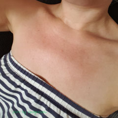 Mein Dekolleté nach 30 Minuten Sonne ab 16 Uhr und ich habe das Spray großzügig verwendet!