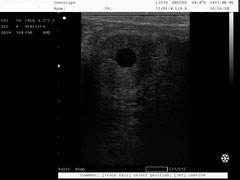 Imagen ecográfica del diagnóstico de gestación temprano, 15 días