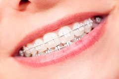 Bei Kindern sind Zahnspangen heute selbstverständlich. Kann man auch bei Erwachsenen noch die Zähne regulieren?
