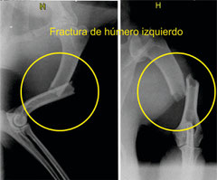 Fractura de húmero izquierdo