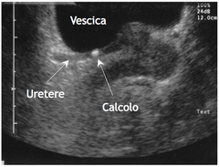 Ecografia vescicale: esempio di calcolo dell'uretere terminale passibile di terapia espulsiva