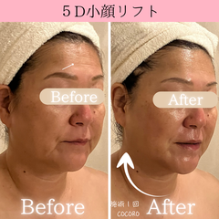 小顔・たるみケア　ビフォーアフター
