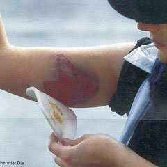 Versuch ein mediales Tattoo am Oberarm mit Laser zu entfernen