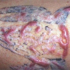 Nahaufnahme des Versuches, ein Tattoo mit Laser zu entfernten