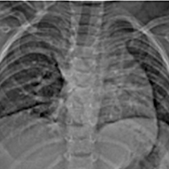 Radio thorax : sur la face : atélectasie du lobe moyen et inferieur droit ou hyperaeration du poumon droit, hile pulmonaire gauche abaissé, déviation trachéale vers la gauche, et abaissement de la carène, sur le profil : bombement de l’artère pulmonaire d