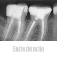 Endodoncia