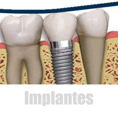 Implantes Dentales