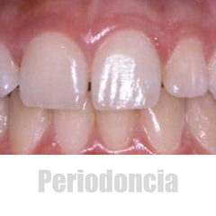 Periodoncia