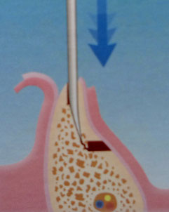 Darstellung der bone-splitting Methode im zahnlosen Unterkiefer