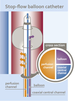 Schematische Darstellung eines Stop-flow-Ballonkatheters mit Querschnittsansicht, die Perfusionskanal, Ballon und koaxialen Zentralkanal zeigt.