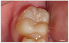 Fissuren-Versiegelung: Schutz für die Backenzähne vom Zahnarzt! (© Doc R)