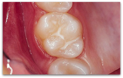 Fissuren-Versiegelung: Schutz für die Backenzähne vom Zahnarzt! (© Doc S)