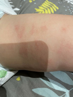 eczema sec