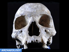 medieval skull with leprosy