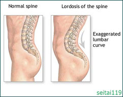 胸椎後湾が強くなると、腰椎前湾も強くなります