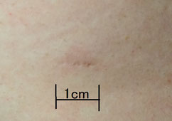 術後２年経過した後の傷　約１ｃｍ