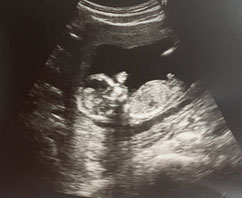 妊婦健診での胎児エコー写真