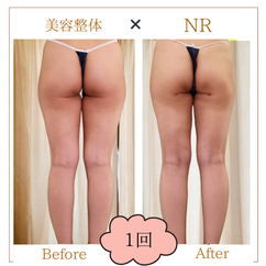 肩こり・巻き肩　ビフォーアフター
