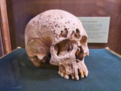 Human skull exhumed from a mass grave of executed witches in southern Latvia, on display in the Jelgvava Museum of Art and History