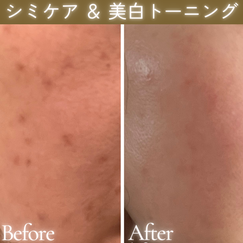 シミケア　ビフォーアフター
