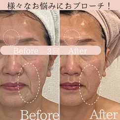 セルラム　ビフォーアフター