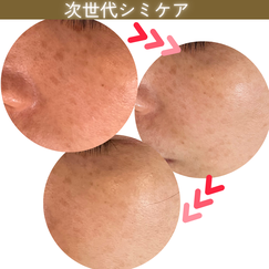 シミケア　ビフォーアフター