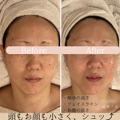 小顔ケア　ビフォーアフター