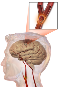 An Embolic Stroke Image: Wikicommons