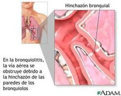 Bronquiolitis, fisipatologia.